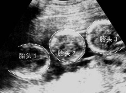 促排完打破卵针了做试管移植要间隔多久时间？